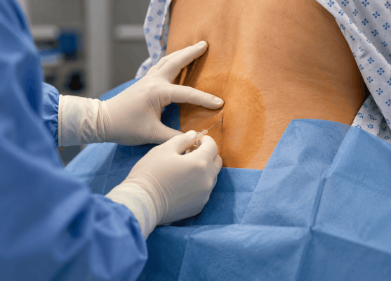 La epidural en el parto: todo lo que necesitas saber Profesional sanitario aplicando la anestesia epidural en la zona lumbar de una mujer durante el parto